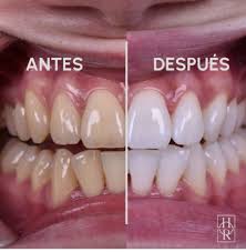 BLANQUEADOR DE DIENTES EN POLVO CON CARBÓN ACTIVADO - MIRACLE TEETH